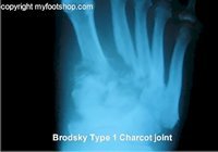 Charcot_joint
