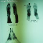 bone scan feet