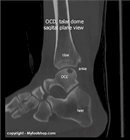 MRI_of_a_osteochondral_fracture-of_the_talus