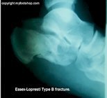 x-ray calcaneal fracture