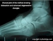 Charcot_joint_midfoot