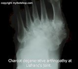 Charcot_joint_x-ray_AP_view