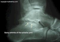 Gouty_arthritis_subtalar_joint