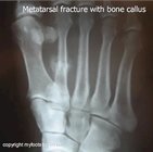bone callus in metatarsal stress fracture