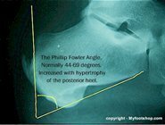 Phillip-Fowler_angle