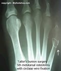 tailor's_bunion x-ray