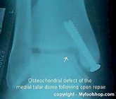 x-ray_of_a_osteochondral_fracture-of_the_talus