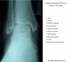 Picture of X-ray of the Ankle - Anterior-Posterior View