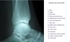 Picture of X-ray of the Ankle - Lateral View