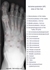 Picture of X-ray of the Foot - Anterior-Posterior View