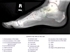Picture of X-ray of the Foot - Lateral View