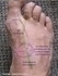 Picture of Deep Peroneal Nerve Entrapment