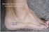 Picture of Distribution of the Sural Nerve on the posterior lateral ankle