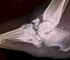 Picture of Charcot Joint