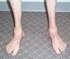Picture of Charcot Marie Tooth Disease
