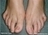 Picture of Claw Toe