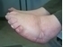 Picture of Club Feet