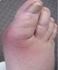 Picture of Gout