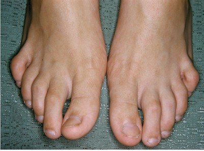 Hammer toes, Causes and treatment options