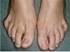 Picture of Hammer Toes