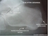 Picture of Heel Spur