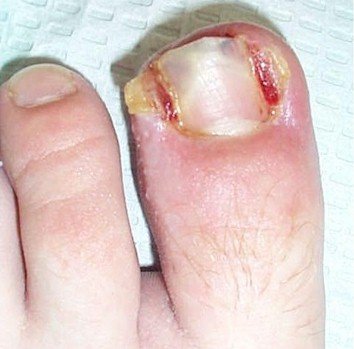 Ingrown Toe Nails | Causes and treatment options 