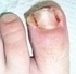 Picture of Ingrown Toe Nail