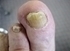 Picture of Onychomycosis