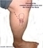 Picture of Peroneal Palsy