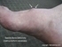 Picture of Saddle Bone Deformity