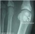 Picture of Sesamoid Fracture