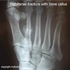 Picture of Stress Fractures of the Foot