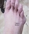 Picture of Tailor's Bunion