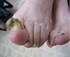 Picture of Toe Nail Fungus