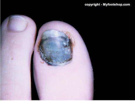 Paronychia | Symptoms of a Nail Infection & How To Treat It | Buoy