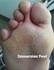 Picture of Trench Foot