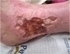 Picture of Venous Stasis Dermatitis and Venous Ulcerations