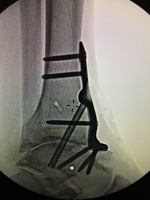 Ankle fusion – improved walking following ankle fusion with the use of a Carbon Fiber Spring Plate