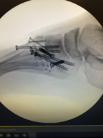 Early and late stage management of Lisfranc fracture-dislocation with a Carbon Fiber Spring Plates