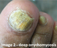 Fungal Toe Nail Treatment – The Two-Step Method