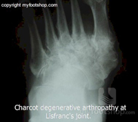 Lisfranc’s fracture and fixation questions