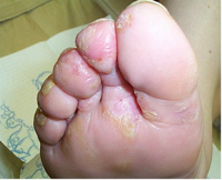It’s not just dry feet – it’s a fungal infection!
