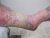 Venous Stasis Dermatitis