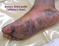 Chronic dry skin of the foot?  Consider t. rubrum.