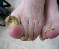 Fungal toe nails – chemically debride, naturally treat