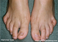 Hammer Toe Pads - Which hammer toe pad is right for me?