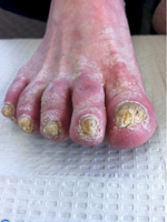 How is 40% urea used to treat fungal infections of the toe nail?