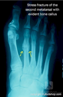 Do I have a metatarsal stress fracture?
