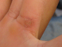 How can you tell the difference between a wart and a callus?