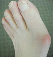 Hammer Toe and Bunion Products